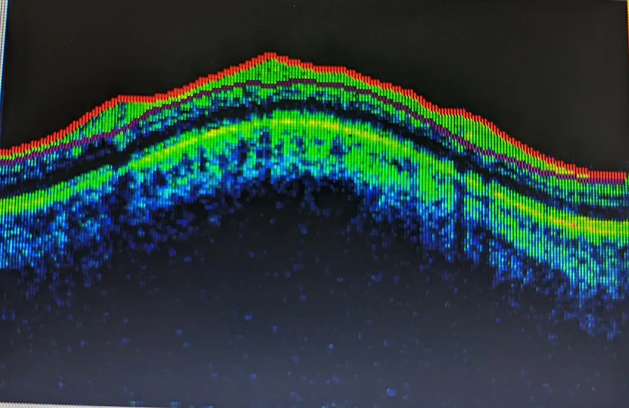 OCT scan of retina