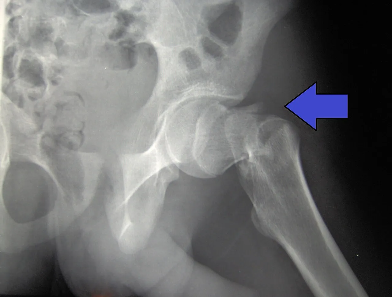 hip fracture x-ray