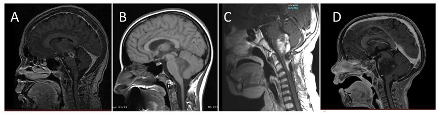 diffuse intrinsic pontine glioma MRI
