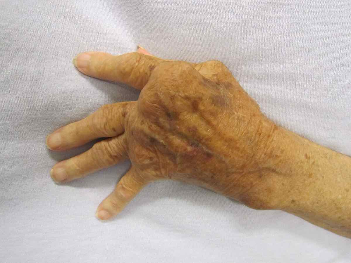 Rheumatoid arthritis hands